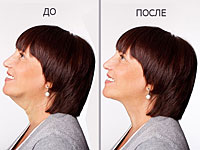 Морщины, двойной подбородок и дряблая шея. Боитесь подтяжки? Есть другое решение
