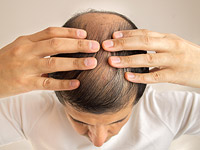 Найдено новое средство от облысения