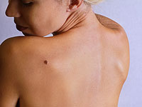 Меланому можно будет диагностировать с помощью анализа крови