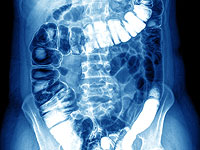 Ювелиру с Мармариса вернули проглоченное туристом кольцо