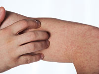 Туристы, посетившие Израиль, привезли корь в сатмарскую общину в США