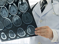 FDA одобрило к использованию израильский алгоритм быстрого выявления внутричерепных кровотечений