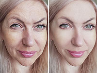 Доказано: процедура Embrace подтягивает кожу и омолаживает ее на долгий срок
