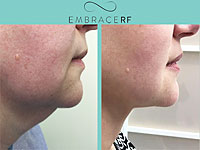 Доказано: процедура Embrace не только подтягивает кожу шеи, но и омолаживает ее
