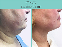 Подтяжка и омоложение кожи шеи: теперь можно обойтись без пластической операции