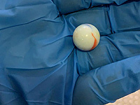 Врачи спасли 7-месячную девочку, подавившуюся игрушкой