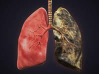 Ученые: у тех, кто бросил курить, легкие