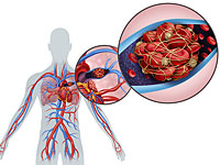 Tages-Anzeiger: препараты, разжижающие кровь, могут снизить смертность от коронавируса