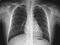 Коронавирус может вызывать у детей синдром Кавасаки: новые данные