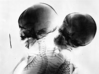 Скончались Ронни и Донни Гэлион, старейшие в мире сиамские близнецы