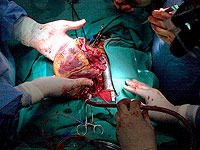 В Лос-Анджелесе донорское сердце 