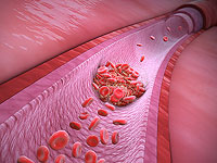 Теперь ученым известно, почему COVID-19 приводит к опасным тромбам