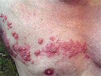 Исследование в Израиле: в 1% случаев после вакцинации от коронавируса у людей с аутоиммунными заболеваниями может возникнуть опоясывающий лишай