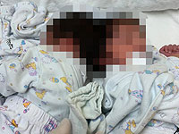 В Израиле впервые проведена операция по разделению сиамских близнецов, соединенных головами