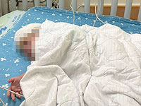 В Израиле впервые проведена операция по разделению сиамских близнецов, соединенных головами
