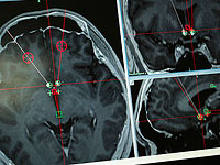 Клиническое исследование: новое лечение уничтожает раковые опухоли головы и шеи