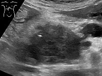 Израильское исследование помогает разработать новые методы лечения рака поджелудочной железы