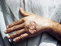 Около 100 военнослужащих ЦАХАЛа на юге страны заразились лейшманиозом