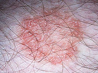 Иерусалимский ребенок заболел стригущим лишаем: родителям стоит проверить детей