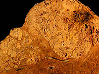 Наноразмерный полимер успешно атакует метастазы в печени