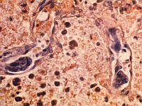 ИИ обучили находить источник скрытого рака по метастазам