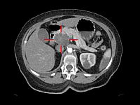 Разработан новый метод ранней диагностики рака поджелудочной железы
