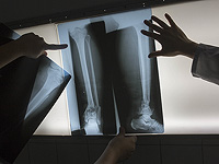 Крошечные имплантируемые датчики помогают сломанным костям зажить за недели вместо месяцев