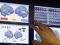 Исследователи составили карту способностей мозга к самовосстановлению после инсульта