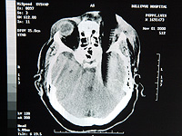 Хирурги смогли удалить опухоль мозга через глаз, впервые в истории