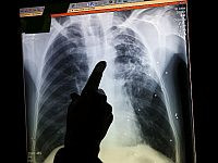 Минздрав сообщает: у пяти малышей в Реховоте диагностирован легочный туберкулез