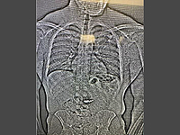 Мужчина проглотил украденные серьги Tiffany, прежде чем его задержала полиция