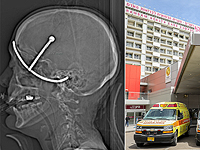 В РАМБАМ спасли женщину с подставкой для полотенец, пробившей глаз и мозг