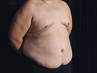 Жировые клетки у разных людей и по-разному влияют на ожирение