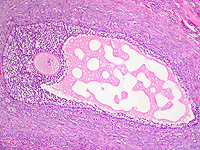 Микропластик впервые обнаружен в фолликулярной жидкости яичников человека