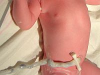 Исследование показало, что пуповина может содержать подсказки о будущем здоровье ребенка