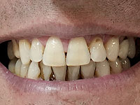 Бактерии в деснах могут нанести вред вашему сердцу