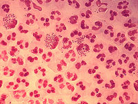 Первая в мире вакцина от гонореи запущена на фоне роста числа случаев заражения