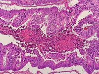 Недостаток кислорода способствует росту рака толстой кишки