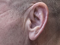 Генная терапия восстановила слух у глухих пациентов