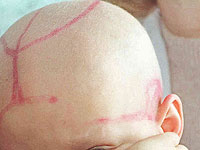 Новая технология может помочь онкологическим больным сохранить волосы во время химиотерапии