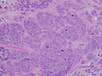 Найдено лекарство, уничтожающее белок-защитник агрессивного рака молочной железы