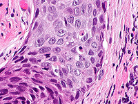 ИИ сможет диагностировать рак голосовых связок на ранней стадии