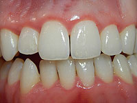 Натуральная молекула удаляет 90% зубного налета, вызывающего кариес