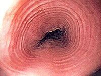 Блокирование одного белка может предотвратить аллергию пищевода