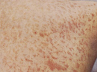 Первый случай заражения корью выявлен в Беэр-Шеве