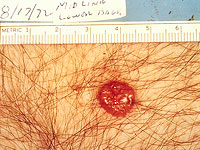 Рак кожи можно выявить за 5 минут с помощью светового теста