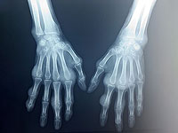 Ученые возрождают древний ген для борьбы с подагрой