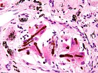 Разработана молекула, блокирующая рост рака легких без вреда для здоровых клеток