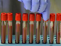 Исследование показало, что группа крови влияет на риск раннего инсульта