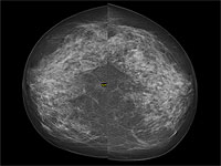 Отсутствие первой маммографии повышает риск смертности от рака молочной железы